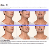 BOTOX 