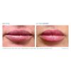 Before and After Lip Treatment