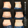 CoolSculpting® Elite Midsection Makeover