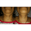 Forma RF Skin Tightening