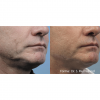 Forma RF Skin Tightening