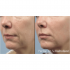 Forma RF Skin Tightening