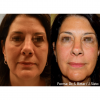 Forma RF Skin Tightening