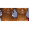 Forma RF Skin Tightening