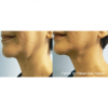 Forma RF Skin Tightening