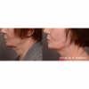 Forma RF Skin Tightening
