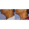 Forma RF Skin Tightening