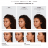 Juvederm Voluma XC B&A