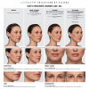 JUVÉDERM VOLLURE™ XC  Before and After