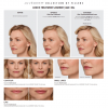 JUVÉDERM VOLLURE™ XC  Before and After