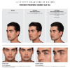 JUVÉDERM® VOLUX™ XC