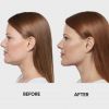 Kybella