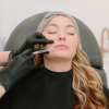 Lip Filler
