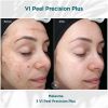 Melasma_01