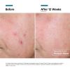 RGN PDP ALT 13 BEFORE + AFTER V1