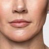 Restylane® Contour