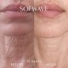 Sofwave before & after