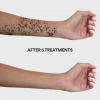 Spectra for Laser Tattoo Removal
