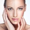 Acne Extractions