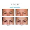Aethern® Advanced Skin Beauty Program - Before and After