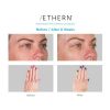 Aethern® Advanced Skin Beauty Program - Before and After