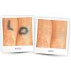 Laser Tattoo Removal  Before & After One