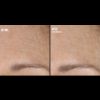  Skinbetter Science®  Regenerating AlphaRet® Intensive Overnight Cream Before & After