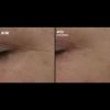  Skinbetter Science®  Regenerating AlphaRet® Intensive Overnight Cream Before & After