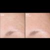  Skinbetter Science®  Regenerating AlphaRet® Intensive Overnight Cream Before & After