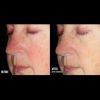 skinbetter Science Alto Defense Serum™ Before & After