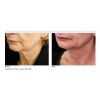 INFINI High Intensity Focused RF Microneedling  (10 Options)