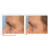 INFINI High Intensity Focused RF Microneedling  (10 Options)