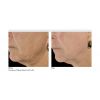 INFINI High Intensity Focused RF Microneedling  (10 Options)