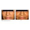 INFINI High Intensity Focused RF Microneedling  (10 Options)