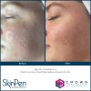 SkinPen®  Microneedling with PRP