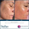 SkinPen®  Microneedling with PRP