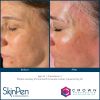 SkinPen®  Microneedling with PRP
