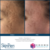SkinPen® Microneedling