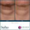 SkinPen®  Microneedling with PRP