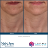 SkinPen® Microneedling