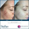 SkinPen® Microneedling