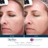 SkinPen® Microneedling