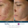 SkinPen® Microneedling