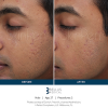 SkinPen Microneedling (4 options 3 addons) Spa Service