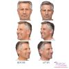 BOTOX® by the Unit (min 20cc)