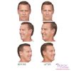 BOTOX® by the Area - Face (3 options)