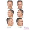 BOTOX® by the Area - Face (3 options)