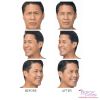 BOTOX® by the Area - Face (3 options)
