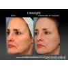 Limelight IPL before and after