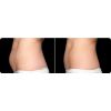 CoolSculpting before and after